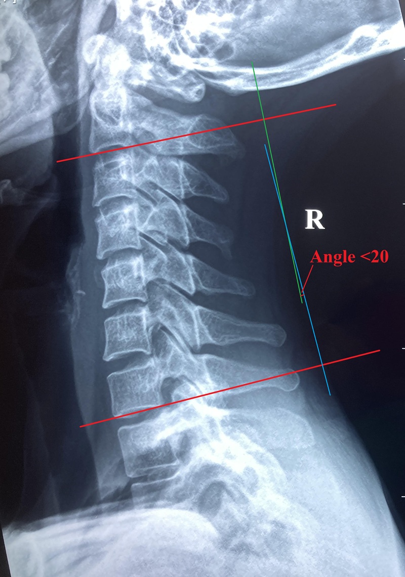 Cervical decreased lordosis 